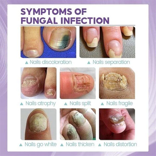 ⁦رذاذ أظافر القدمين medinail sponge spray⁩ - الصورة ⁦6⁩